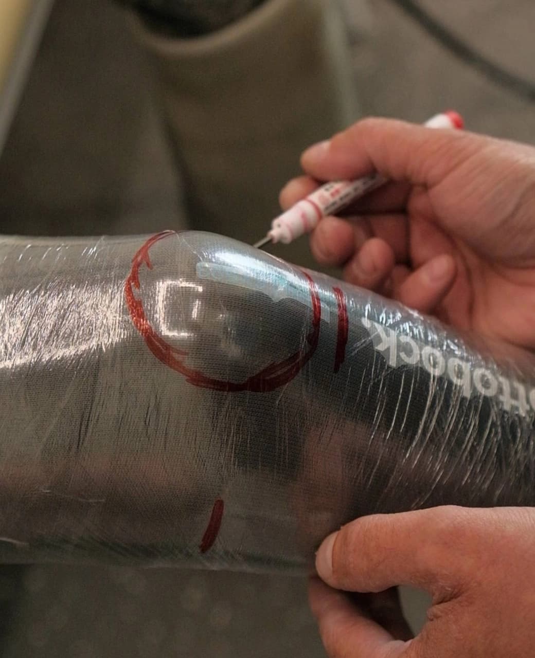 Профилактика контрактур: протезирование голени